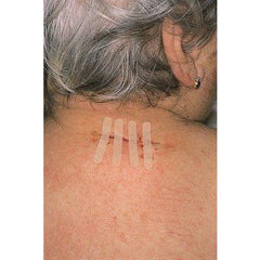 Omnistrip Skin Closure - 3 Strips 6mm x 76mm